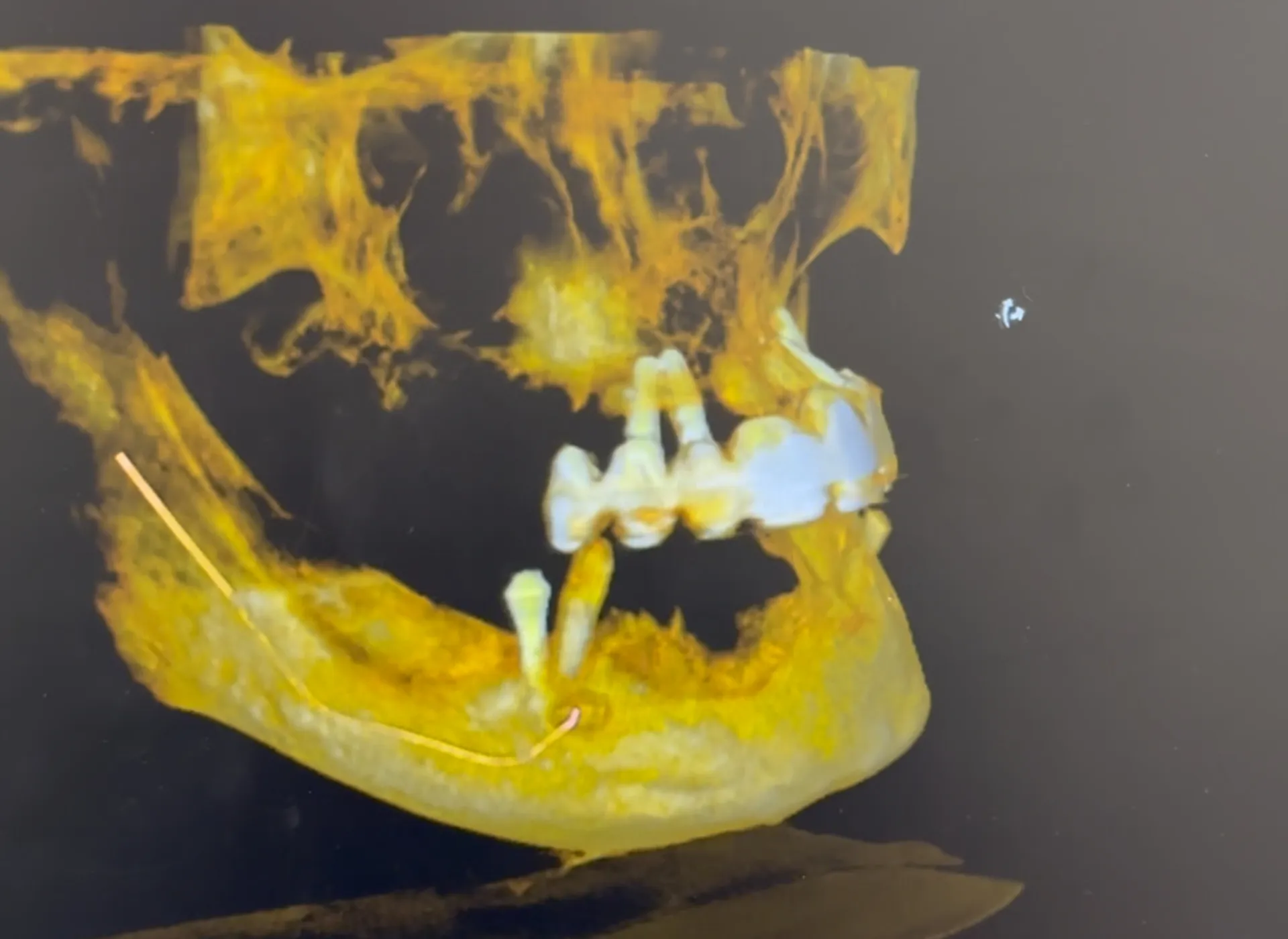costi degli impianti dentali