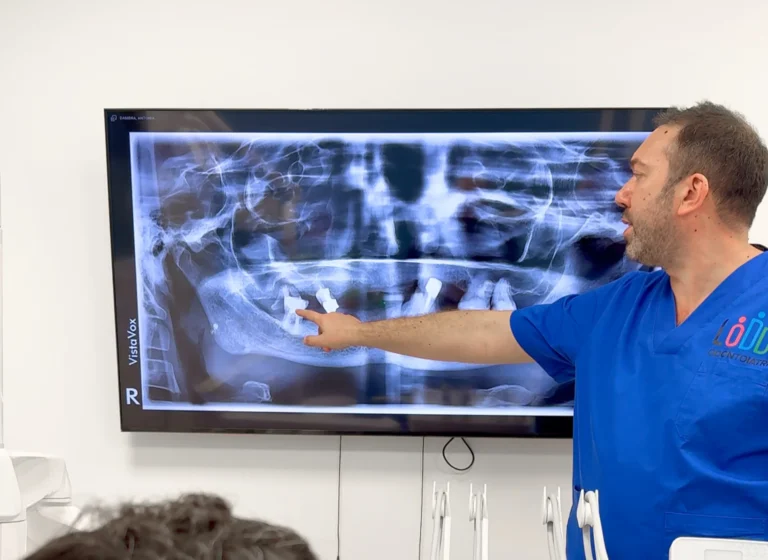 Come funziona un impianto dentale