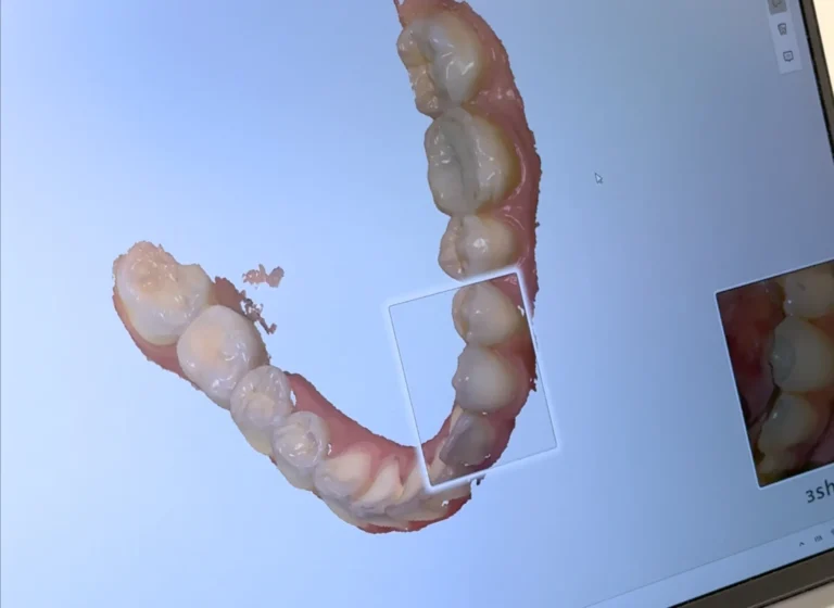 Differenze tra apparecchio messo da bambini e da adulti