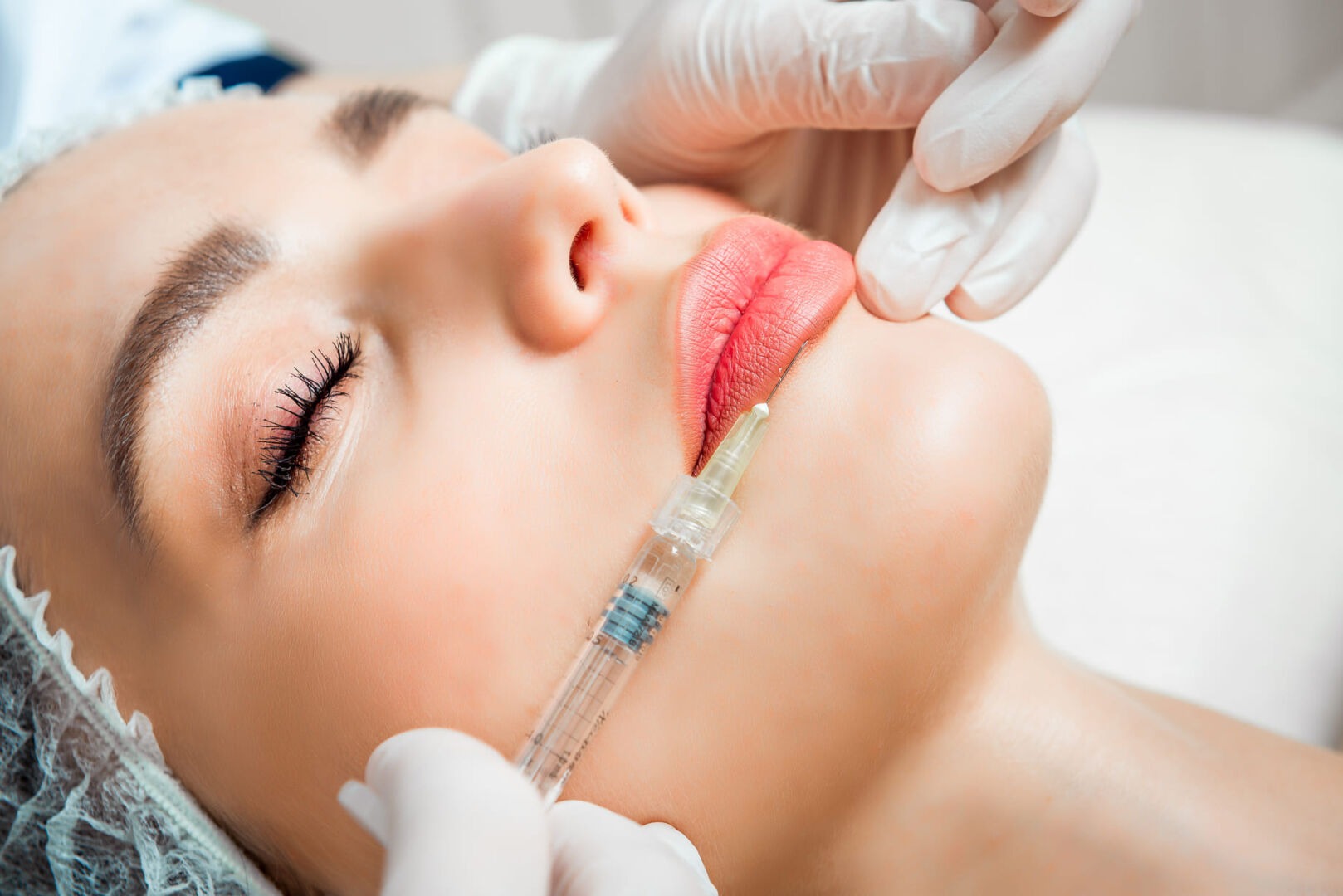 Filler labbra per aumentare il volume in modo naturale