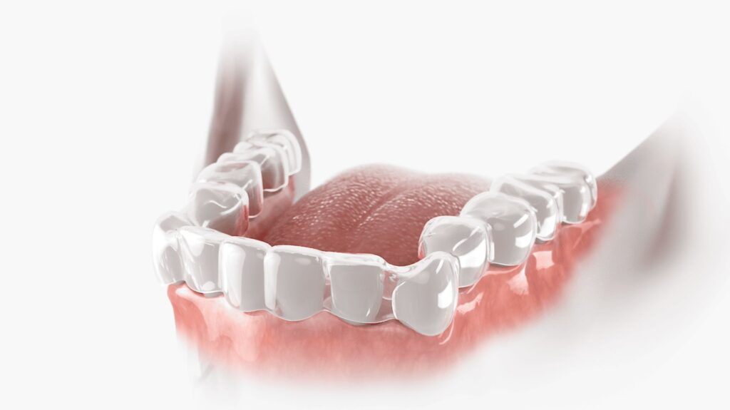 Apparecchio trasparente a Casal Monastero