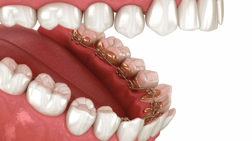 Apparecchio linguale a Casal Monastero